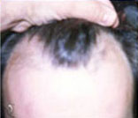 PRP Hair Loss Replacement Before and After Photo by Coachlight Clinic & Spa in West Des Moines Iowa