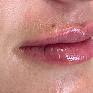 Lip Filler Before and After Photo by Coachlight Clinic & Spa in West Des Moines Iowa