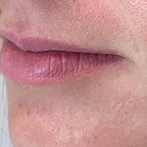 Lip Filler Before and After Photo by Coachlight Clinic & Spa in West Des Moines Iowa