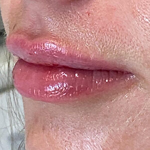 Lip Filler Before and After Photo by Coachlight Clinic & Spa in West Des Moines Iowa