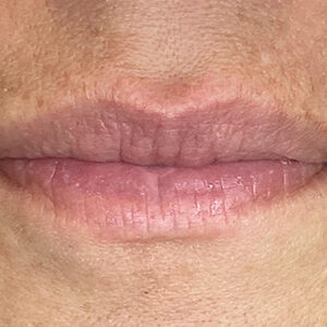 Lip Filler Before and After Photo by Coachlight Clinic & Spa in West Des Moines Iowa