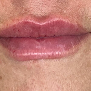 Lip Filler Before and After Photo by Coachlight Clinic & Spa in West Des Moines Iowa