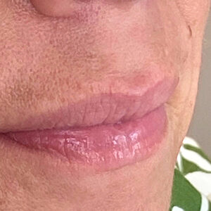 Lip Filler Before and After Photo by Coachlight Clinic & Spa in West Des Moines Iowa