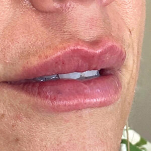 Lip Filler Before and After Photo by Coachlight Clinic & Spa in West Des Moines Iowa