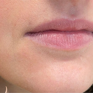 Lip Filler Before and After Photo by Coachlight Clinic & Spa in West Des Moines Iowa