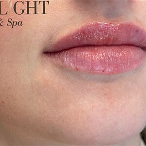 Lip Filler Before and After Photo by Coachlight Clinic & Spa in West Des Moines Iowa