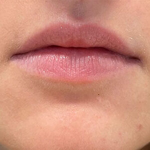 Lip Filler Before and After Photo by Coachlight Clinic & Spa in West Des Moines Iowa