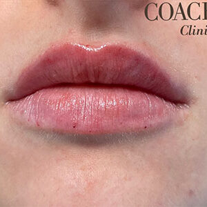 Lip Filler Before and After Photo by Coachlight Clinic & Spa in West Des Moines Iowa