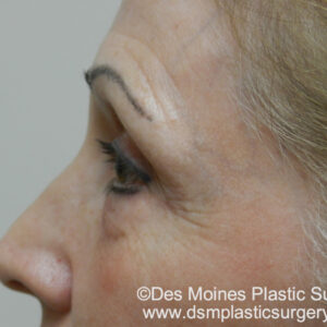 HALO Before and After Photo by Coachlight Clinic & Spa in West Des Moines Iowa