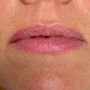 Lip Filler Before and After Photo by Coachlight Clinic & Spa in West Des Moines Iowa