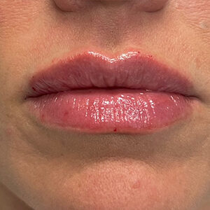 Lip Filler Before and After Photo by Coachlight Clinic & Spa in West Des Moines Iowa