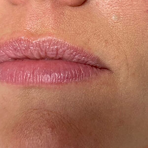 Lip Filler Before and After Photo by Coachlight Clinic & Spa in West Des Moines Iowa