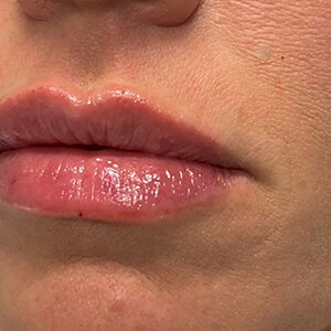 Lip Filler Before and After Photo by Coachlight Clinic & Spa in West Des Moines Iowa