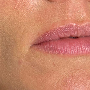 Lip Filler Before and After Photo by Coachlight Clinic & Spa in West Des Moines Iowa