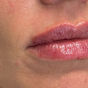 Lip Filler Before and After Photo by Coachlight Clinic & Spa in West Des Moines Iowa