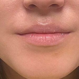 Lip Filler Before and After Photo by Coachlight Clinic & Spa in West Des Moines Iowa