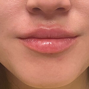 Lip Filler Before and After Photo by Coachlight Clinic & Spa in West Des Moines Iowa