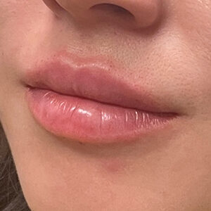 Lip Filler Before and After Photo by Coachlight Clinic & Spa in West Des Moines Iowa