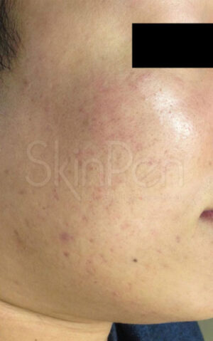 Microneedling with SkinPen Before and After Photo by Coachlight Clinic & Spa in West Des Moines Iowa