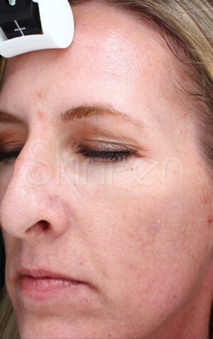 Microneedling with SkinPen Before and After Photo by Coachlight Clinic & Spa in West Des Moines Iowa