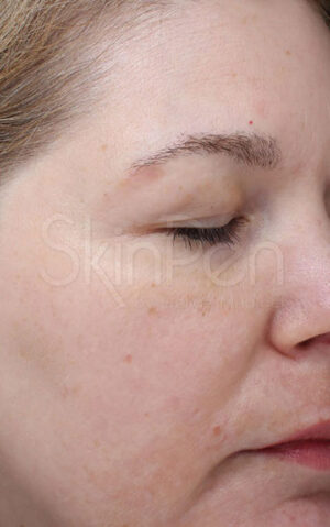 Microneedling with SkinPen Before and After Photo by Coachlight Clinic & Spa in West Des Moines Iowa