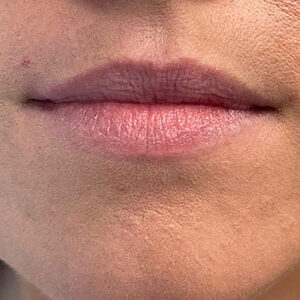 Lip Filler Before and After Photo by Coachlight Clinic & Spa in West Des Moines Iowa