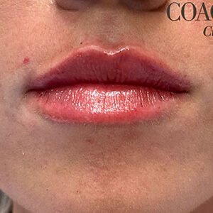 Lip Filler Before and After Photo by Coachlight Clinic & Spa in West Des Moines Iowa