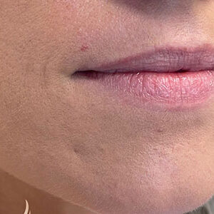 Lip Filler Before and After Photo by Coachlight Clinic & Spa in West Des Moines Iowa