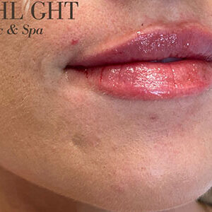 Lip Filler Before and After Photo by Coachlight Clinic & Spa in West Des Moines Iowa