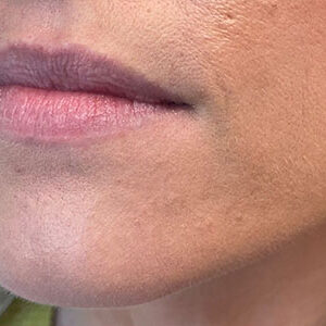 Lip Filler Before and After Photo by Coachlight Clinic & Spa in West Des Moines Iowa