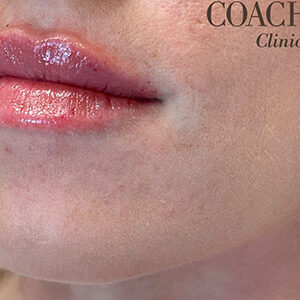 Lip Filler Before and After Photo by Coachlight Clinic & Spa in West Des Moines Iowa