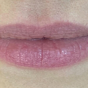 Lip Filler Before and After Photo by Coachlight Clinic & Spa in West Des Moines Iowa