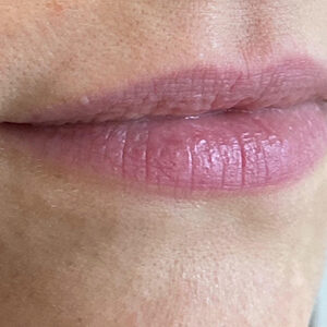 Lip Filler Before and After Photo by Coachlight Clinic & Spa in West Des Moines Iowa