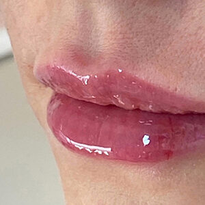 Lip Filler Before and After Photo by Coachlight Clinic & Spa in West Des Moines Iowa