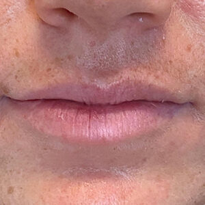 Lip Filler Before and After Photo by Coachlight Clinic & Spa in West Des Moines Iowa