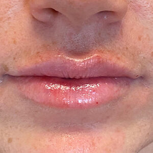 Lip Filler Before and After Photo by Coachlight Clinic & Spa in West Des Moines Iowa