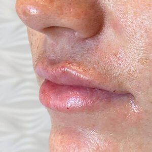 Lip Filler Before and After Photo by Coachlight Clinic & Spa in West Des Moines Iowa