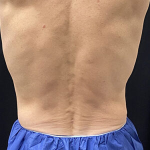 Coolsculpting Before and After Photo by Coachlight Clinic & Spa in West Des Moines Iowa
