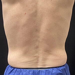 Coolsculpting Before and After Photo by Coachlight Clinic & Spa in West Des Moines Iowa