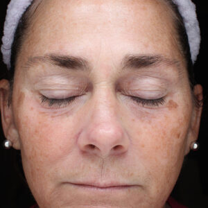 Halo treatment Before and After Photo by Coachlight Clinic Spa in West Des Moines Iowa