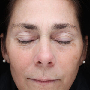 Halo treatment Before and After Photo by Coachlight Clinic Spa in West Des Moines Iowa