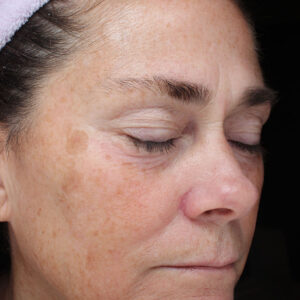 Halo treatment Before and After Photo by Coachlight Clinic Spa in West Des Moines Iowa