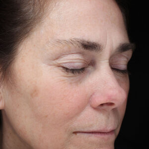 Halo treatment Before and After Photo by Coachlight Clinic Spa in West Des Moines Iowa