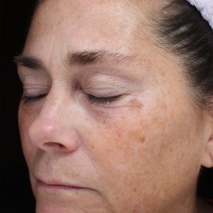 Halo treatment Before and After Photo by Coachlight Clinic Spa in West Des Moines Iowa