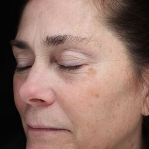 Halo treatment Before and After Photo by Coachlight Clinic Spa in West Des Moines Iowa