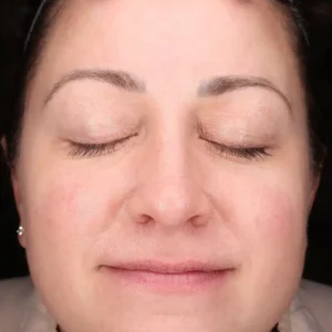 front view after halo treatment