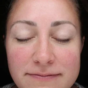 front view before halo treatment