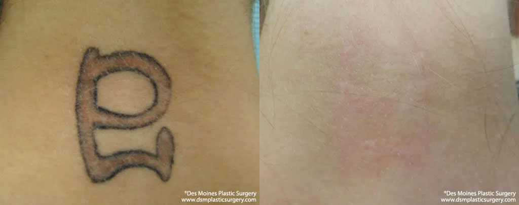 laser tattoo removal before and afters