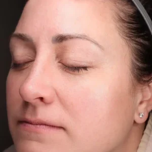 left oblique view after halo treatment