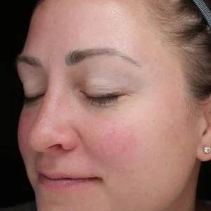 left oblique view before halo treatment